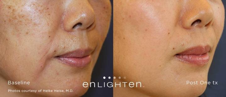 laser skin toning before and after