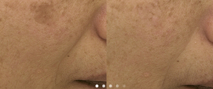 laser skin toning before and after