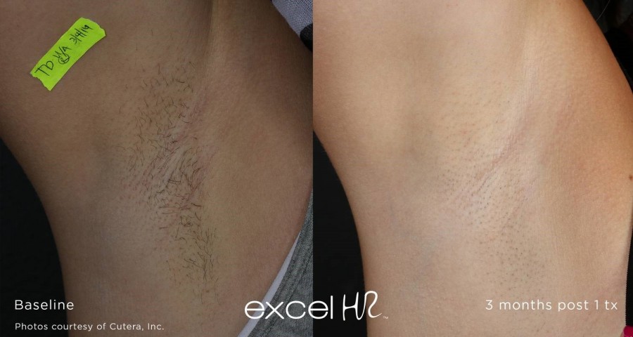 Laser hair removal on a leg.
