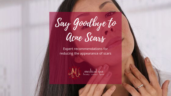 Ways to Reduce Acne Scars