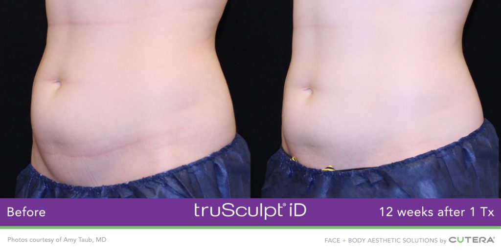 Lose Weight Fast with truSculpt iD