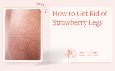 How to Get Rid of Strawberry Legs