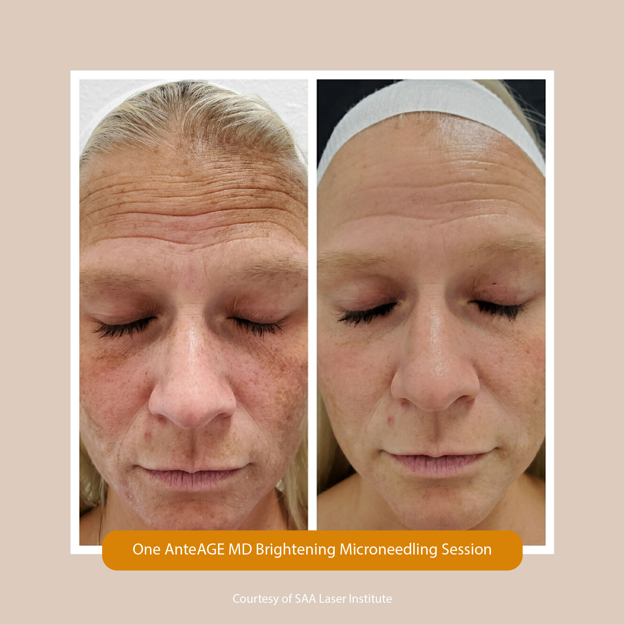 Microneedling with Stem Cells