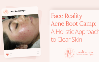 Face Reality Acne Boot Camp: A Holistic Approach to Clear Skin