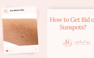 How to Get Rid of Sunspots?