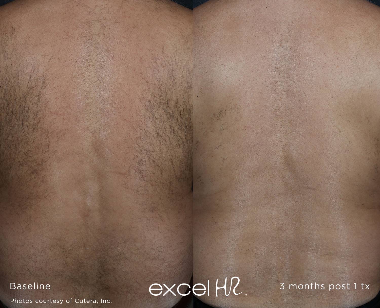 Before and After Laser Hair Removal