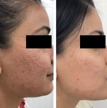 Microneedling before and after image