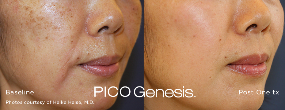 Pico Genesis before and after