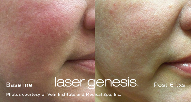 Laser Genesis Before and After Image