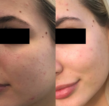 Microneedling before and after image