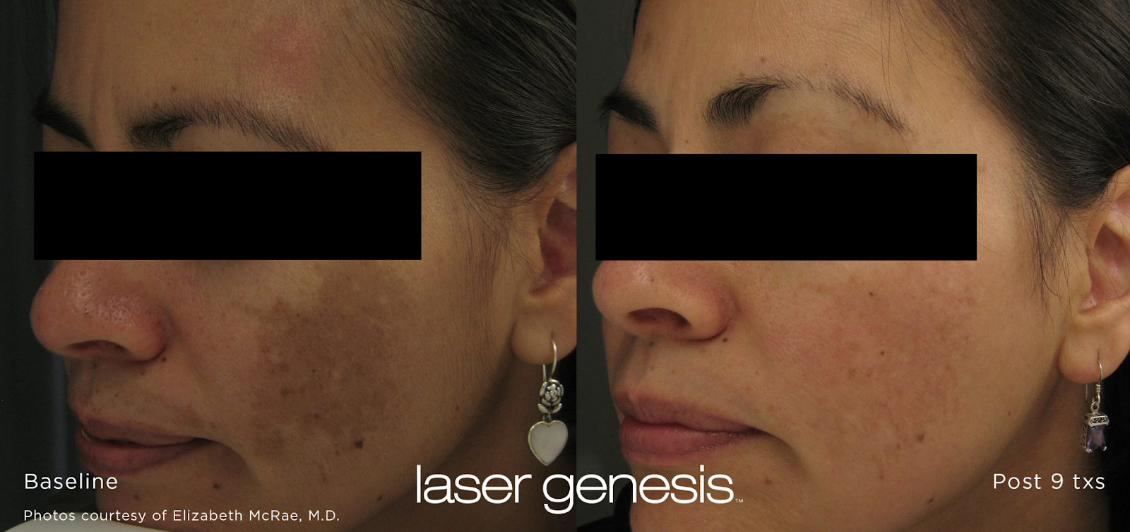 Laser Genesis Before and After Image