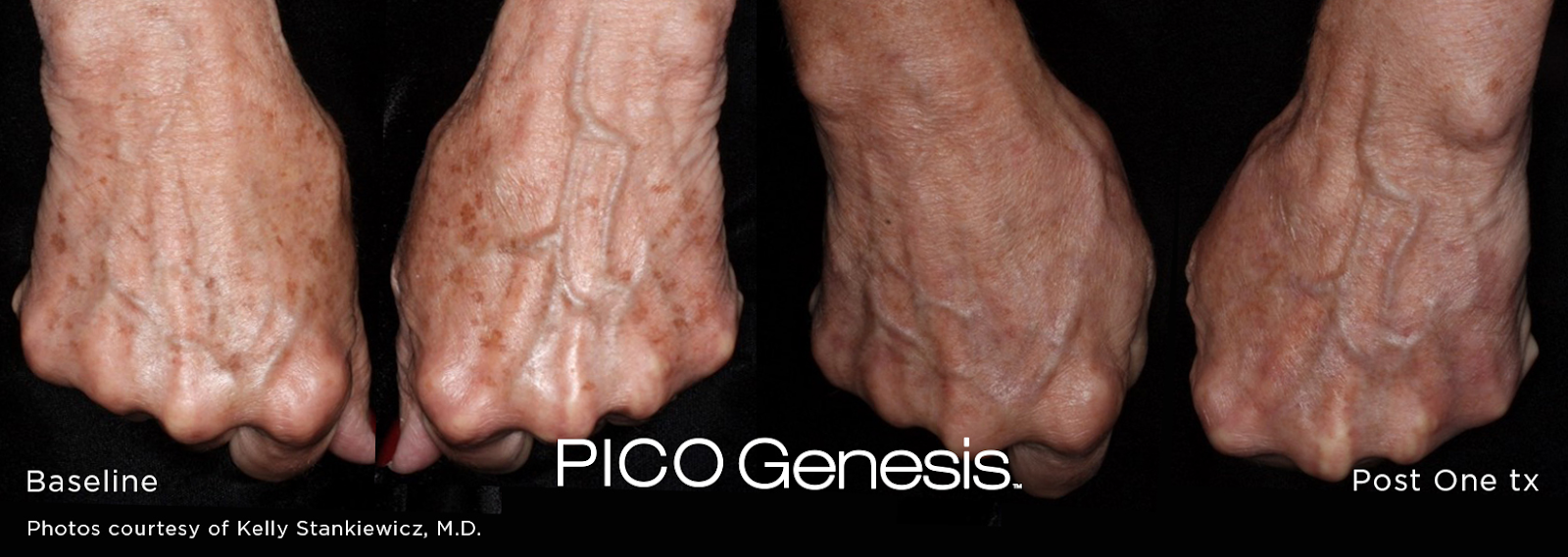 Pico Genesis before and after on hands