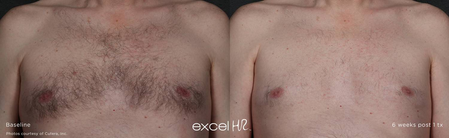 Before and After Laser Hair Removal