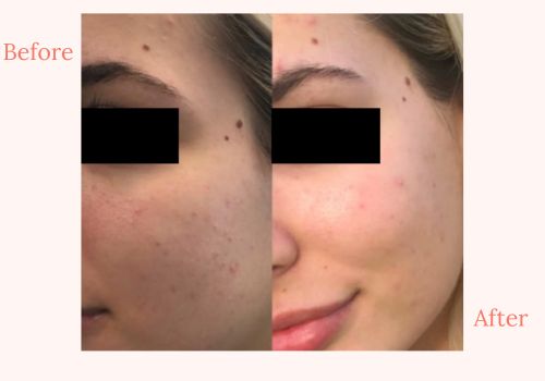 Microneedling Full Face with a complimentary full size VI cleanser!