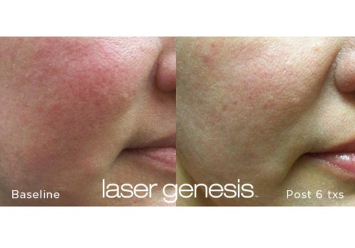 Laser Genesis
