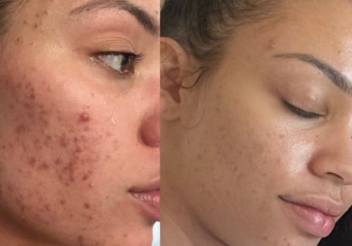 VI Peel with Free Full Size VI Gentle Purifying Cleanser