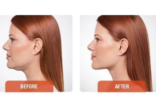 Kybella